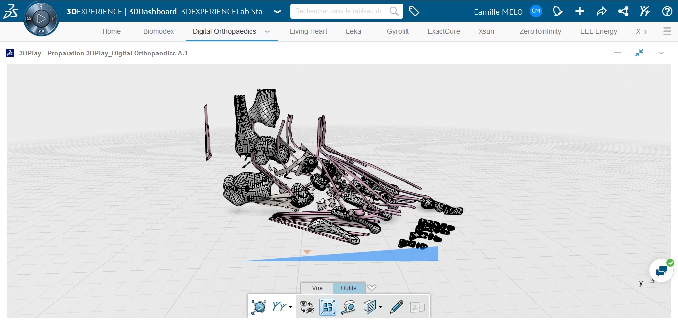 Chirurgien analysant un modèle 3D du pied via la plateforme 3DEXPERIENCE pour une planification orthopédique personnalisée.