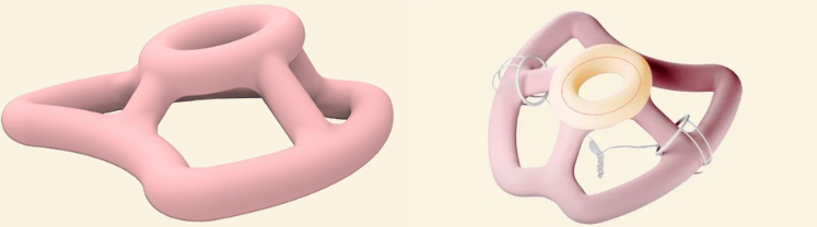 FemTherapeutics' personalized and non-invasive prosthetics prototype