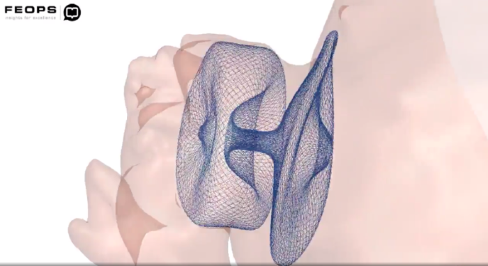 FEops technology for personalized care in structural heart disease