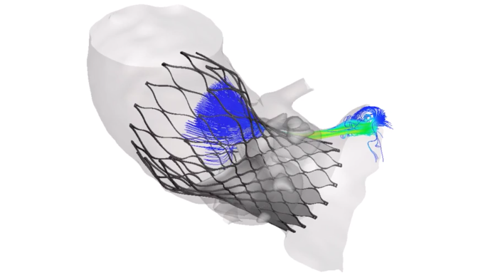 FEops innovation to optimize treatment planning, and improve patient outcomes