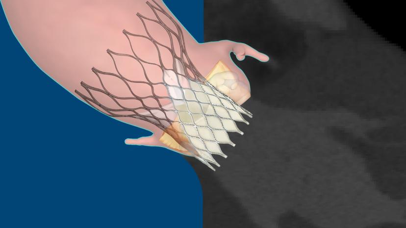 FEops, a startup accelerated by the 3DEXPERIENCE Lab, advancing personalized care in structural heart disease