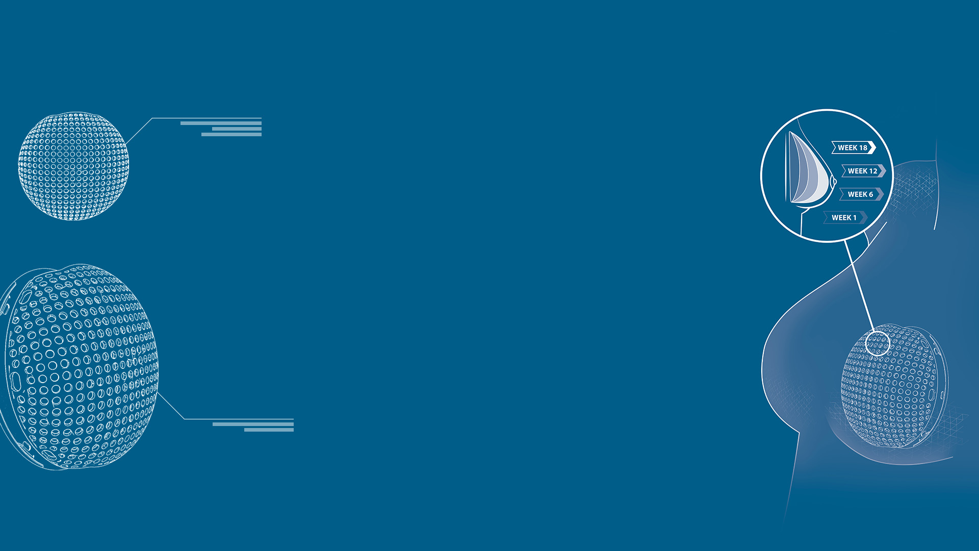 Lattice Medical combining biomaterials, tissue engineering, and 3D printing for breast reconstruction > Dassault Systèmes