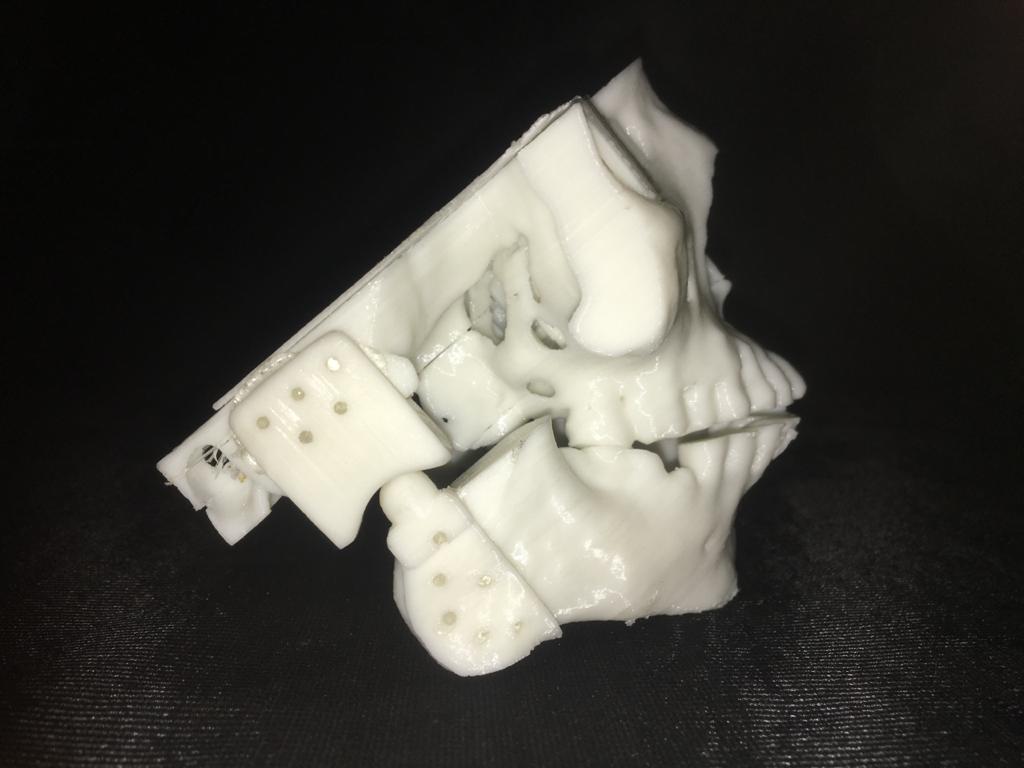 Implants personnalisés innovants pour de meilleurs résultats et une récupération optimisée des patients (112 caractères)