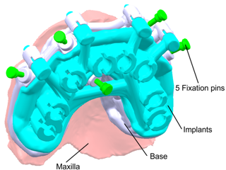 Finite Element Analysis of the Load-Bearing Components of a Stackable Surgical Guide System During Flapless Implant Osteotomy in a Fully Edentulous Maxilla