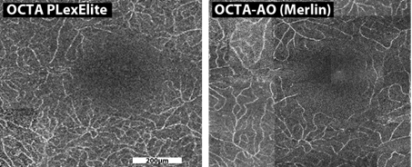 Amélioration de la qualité de l'image de la rétine grâce à l'optique adaptative (à droite)