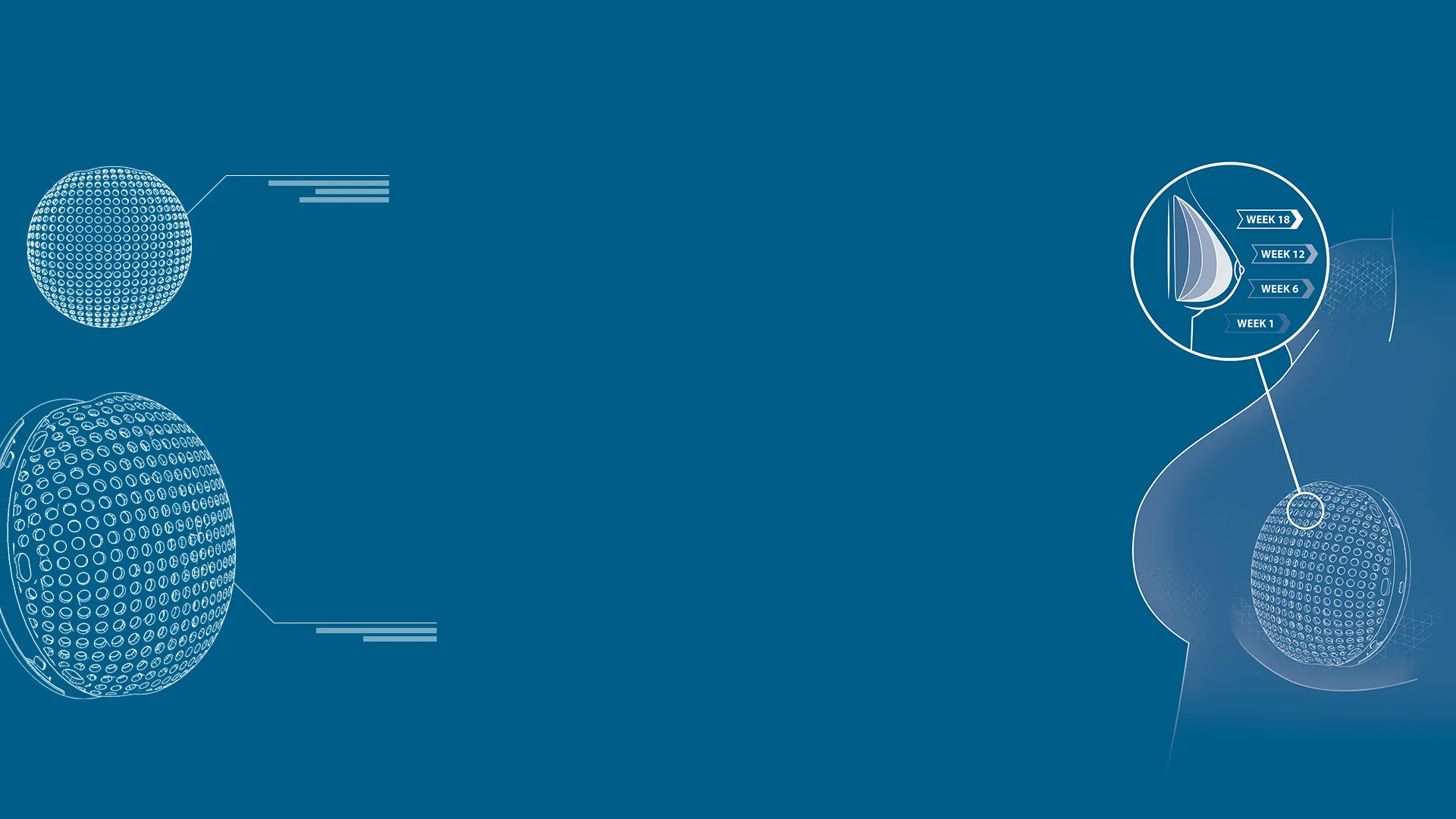 Lattice Medical combining biomaterials, tissue engineering, and 3D printing for breast reconstruction > Dassault Systèmes