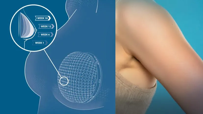 Lattice Medical developing patient-specific surgical implants with tissue engineering and 3D printing > Dassault Systèmes