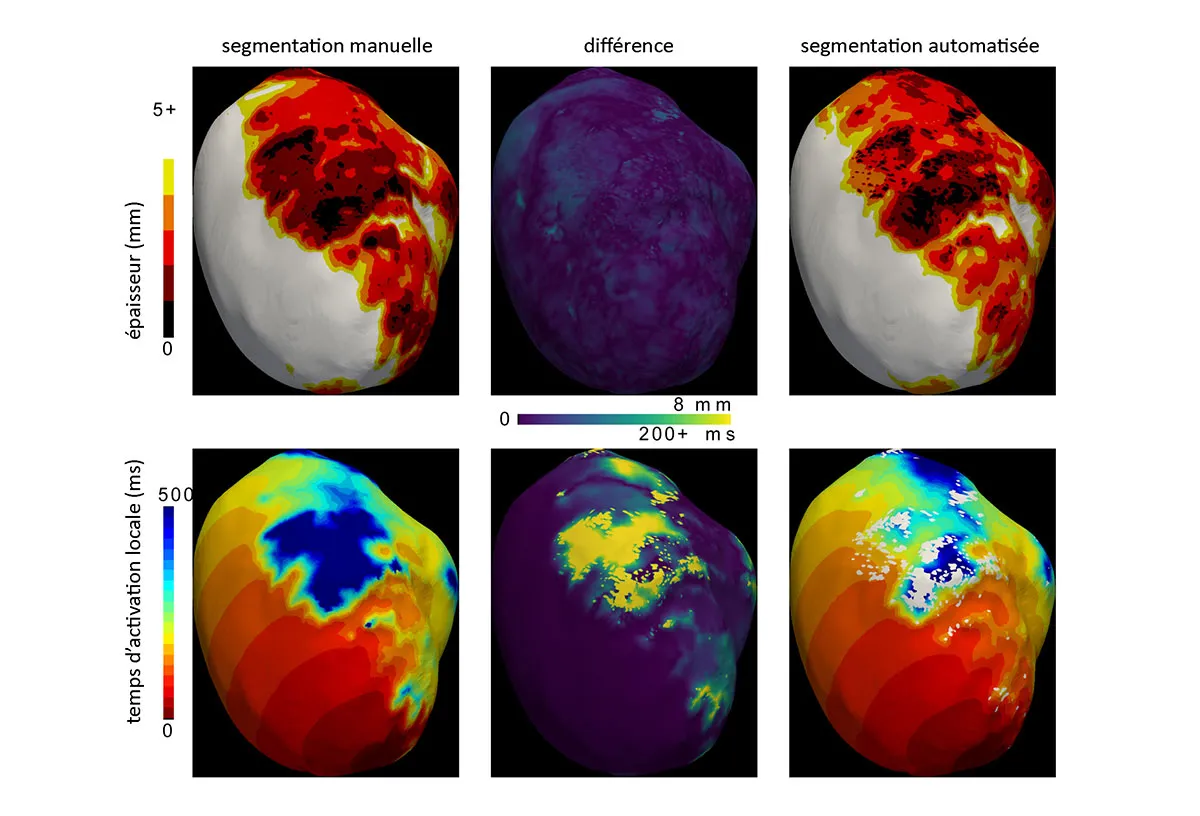 Comparaison entre simulations (avec modèle eikonal) obtenues à partir de segmentations manuelles et automatisées
