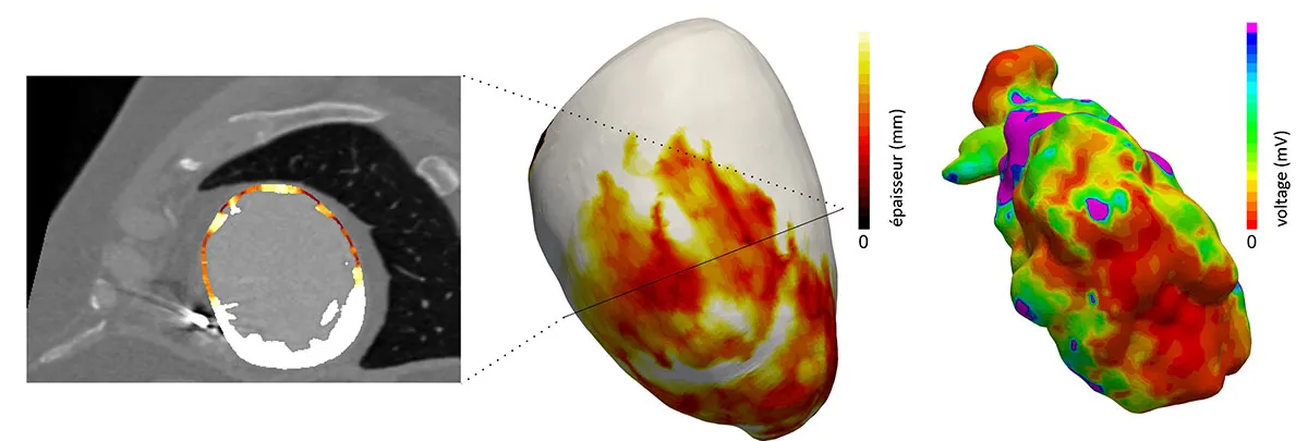 Correspondance entre zone d'amincissement du myocarde (visible sur image CT) et zone de bas-voltage (carte électro-anatomique) 