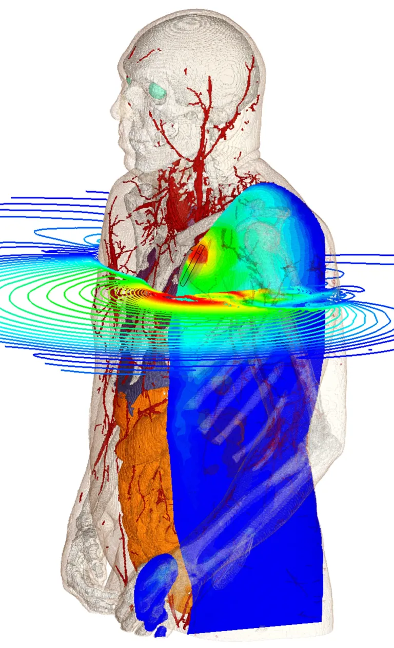 Bioelectromagnetics Simulatio of a Pacemaker > Dassault Systèmes