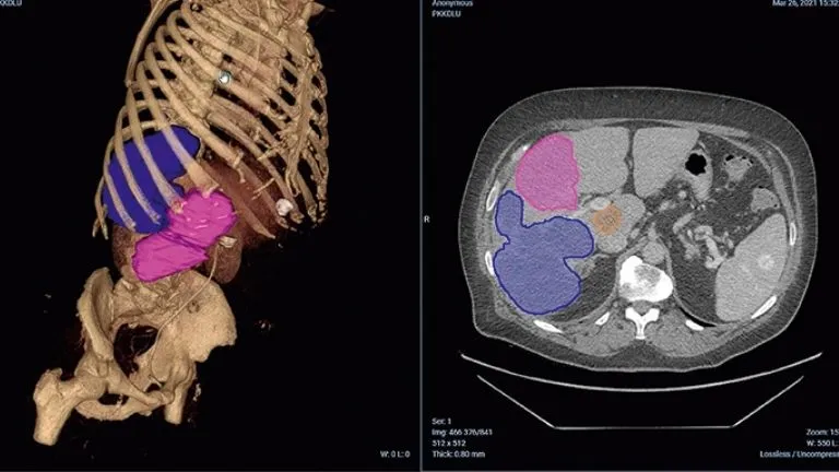 Illustration of a human heart's digital twin showing health insights on the 3DEXPERIENCE platform for patient care.